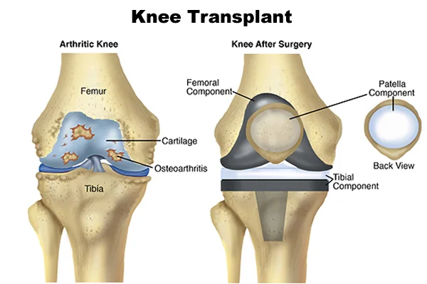 Knee Transplant