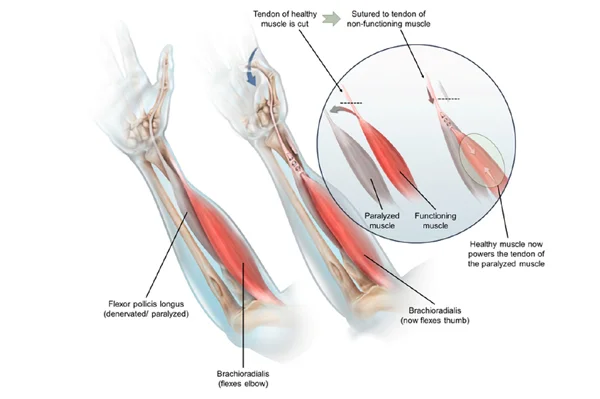 Tendon Surgery