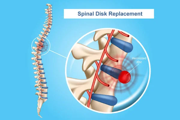 Spinal Surgery